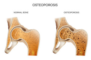 Home Health Care in Fairmont MN: Osteoporosis