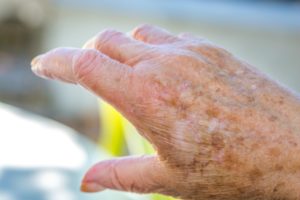 Elder Care in Granite Falls MN: Dry Skin