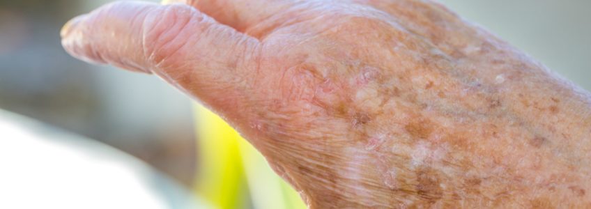 Elder Care in Granite Falls MN: Dry Skin