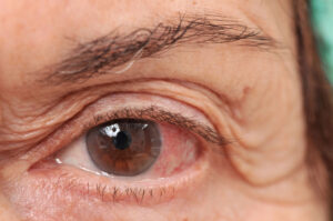 Personal care at home can offer daily support and reminders to seniors with eye issues to practice better health.